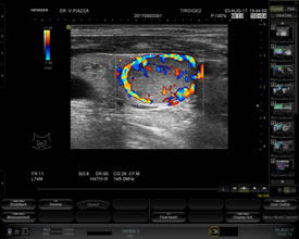 Nodulo all'FNAB TIR 3a-Vascolarizzazione perinodulare